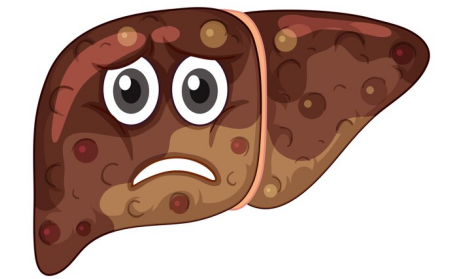 肝癌中晚期一般壽命多少年？治療抉擇至關重要