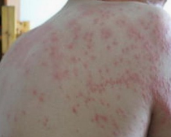 誘發荨麻疹的因素有哪些