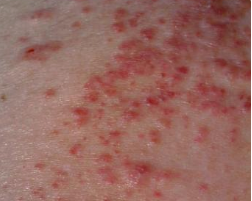 秋季該怎麽預防濕疹的發生