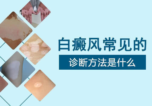 通過這些檢查讓白癜風一目了然