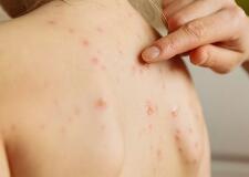 皮膚瘙癢難耐，竟然是它們在作怪