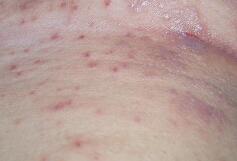 皮膚瘙癢難耐，竟然是它們在作怪