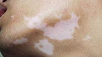 白癜風的成因是什麽?這些也要知道