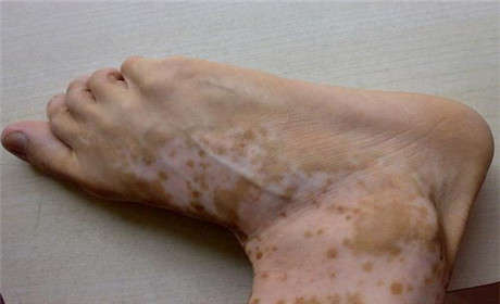 治療白癜風時的注意事項你知道嗎?一定要了解