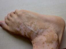 白癜風的檢查項目都有這些，知道了不走冤枉路