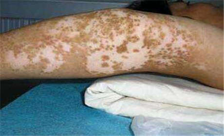 白癜風的發病症狀都有哪些?病情反複很難治愈嗎?