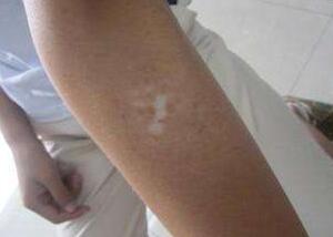 白癜風症狀怎麽治愈，應注意哪些生活細節?