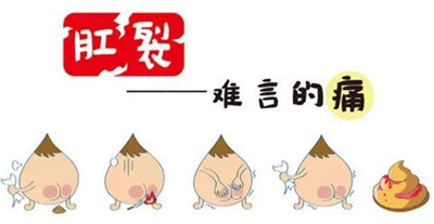 日常生活中肛裂的保健可以做什麽？并不複雜，快來看看！