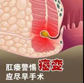 肛瘘的危害有哪些？肛瘘的這些危害我們生活當中千萬不能忽視