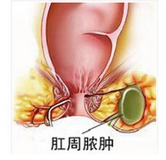 什麽人身上會出現肛周膿腫?一般哪類人群易引發肛周膿腫？