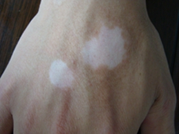 手部白癜風的緻病因素 怎樣治療才有效