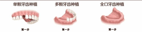 種植牙能用多久？這些知識你都了解嗎？
