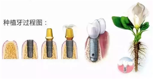 種植牙能用多久？這些知識你都了解嗎？