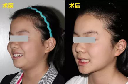 #隐性托槽矯正#案例，選對醫院很重要