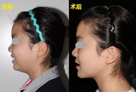 #隐性托槽矯正#案例，選對醫院很重要