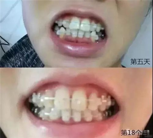 鋼絲矯正和隐性矯正，哪個更值得選擇？