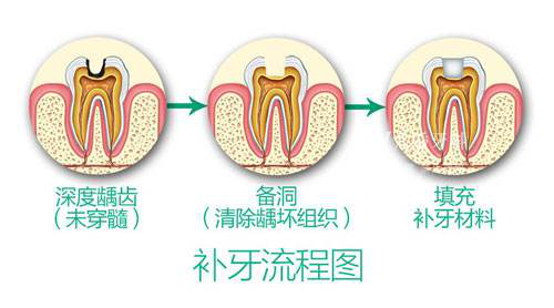 補牙價格差異爲何這麽大？揭秘你不知道的補牙秘密