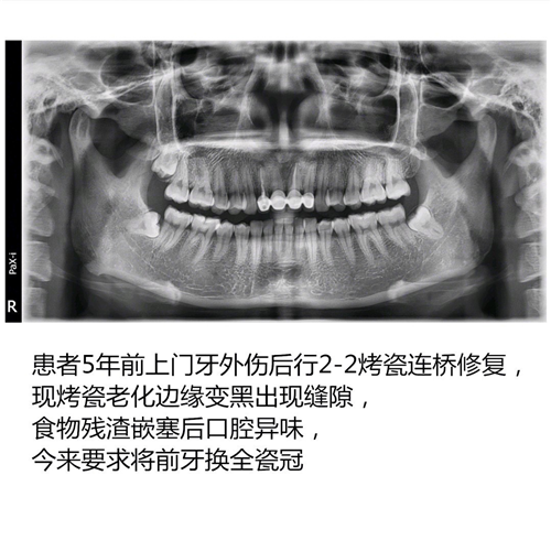  門牙烤瓷老化後全瓷冠修複案例分享