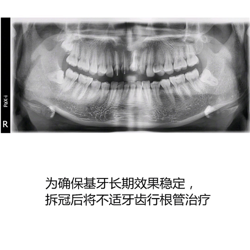  門牙烤瓷老化後全瓷冠修複案例分享