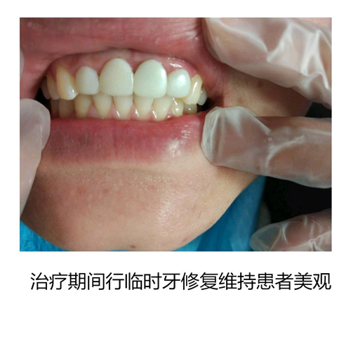  門牙烤瓷老化後全瓷冠修複案例分享