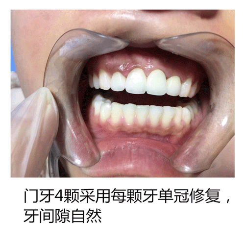  門牙烤瓷老化後全瓷冠修複案例分享