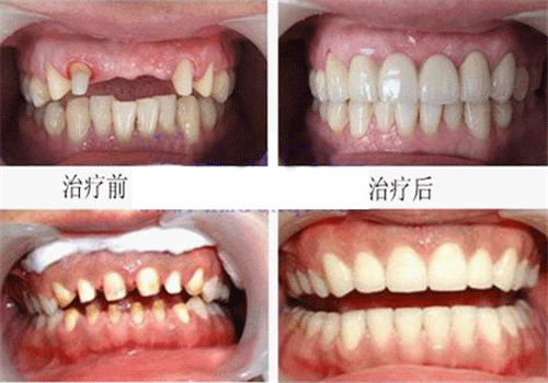 如何選擇烤瓷牙的材料?看完文章就知道