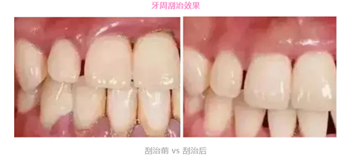 洗牙和牙周刮治有什麽區别？不都是清潔牙齒嗎？