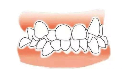 12歲前要處理的10種兒童牙颌畸形