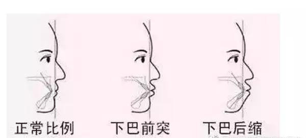 12歲前要處理的10種兒童牙颌畸形