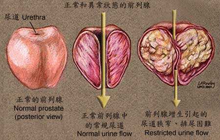 前列腺增生的檢查方法有哪些？知道這幾個方法讓你早發現早治療
