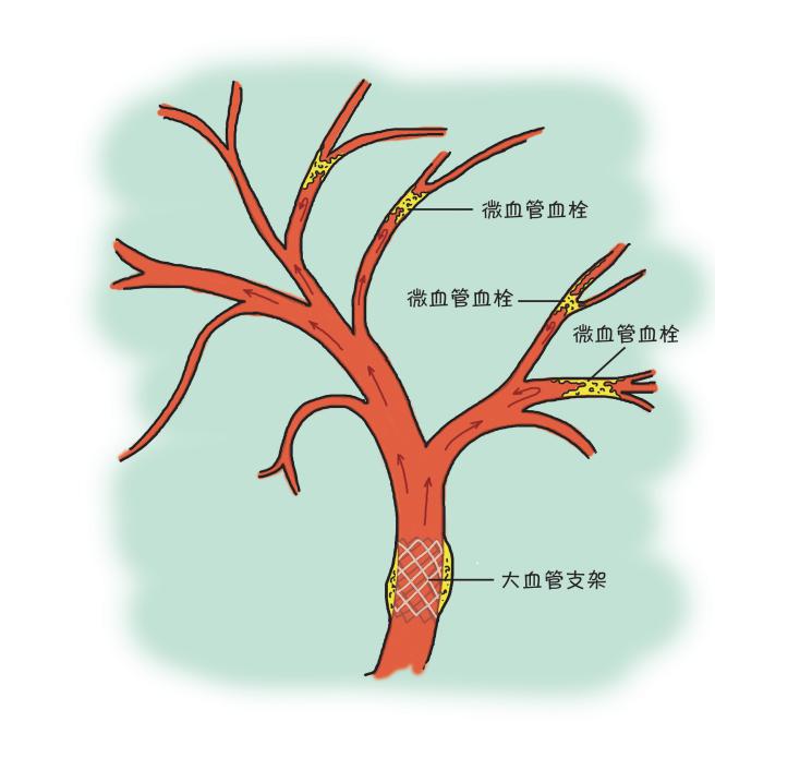 冠狀動脈多支病變如何治療更好？