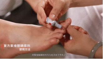 灰指甲早期傳染性強嗎？如何治療灰指甲更有效？