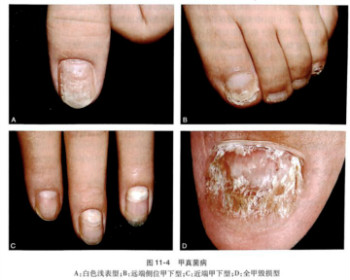 灰指甲藥能連續用多久？用什麽藥物治療好？