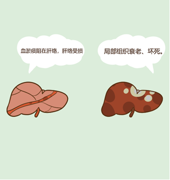軟肝吃什麽好的快？治早期肝纖維化嗎？