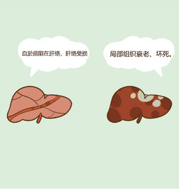 複方鼈甲軟肝片在福建哪裏有賣？早期肝硬化的常用藥該如何選擇？