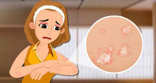 牛皮癬要怎麽護理?南京皮膚病醫院這5大注意事項要牢記在心!