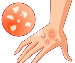 得了嚴重的牛皮癬怎麽辦?蘇州治療牛皮癬醫院哪家好?