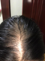 找到治療産後脫發的藥物，産婦不用再發愁