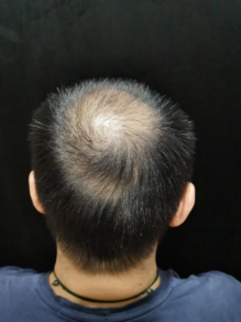 止脫生發液哪個牌子好？選用它效果看得見