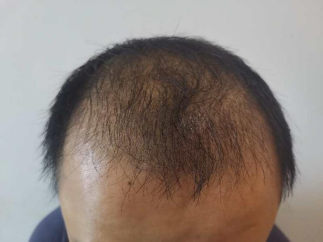 脂溢性脫發如何生發？有什麽好辦法？