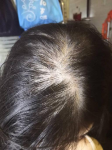 怎麽治療産後脫發？産後脫發還有救嗎？