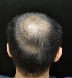 男性脫發怎麽治療效果好？它能幫你解決煩惱！