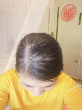 掌握治療産後脫發的好方法，避免入“坑”！