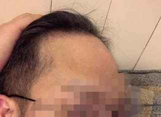 脂溢性脫發能不能治療？快看看方法用對了嗎？
