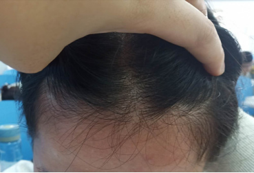 發際線後移如何治療？拯救方法快來看看