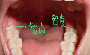 智齒被肉包住了一定要拔嗎，公開拔智齒的原因！
