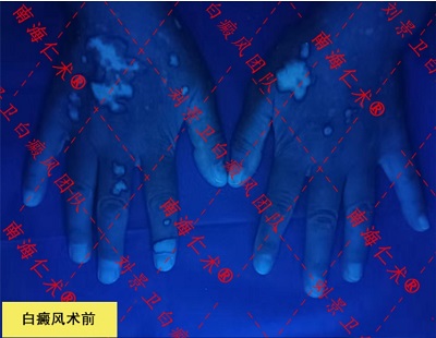 ReCell技術治療白癜風與完整的毛囊外毛根鞘移植術治療白癜風有何不同