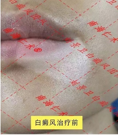 熱點資訊 海南白癜風醫院肢端白癜風治療公認的先進