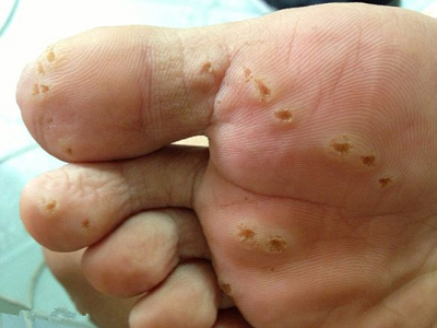 海南皮膚醫院排名榜單 跖疣的治療哪種方法好得快？