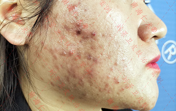 海口哪家皮膚醫院治療痤瘡靠譜？面部痤瘡不可輕視的原因
